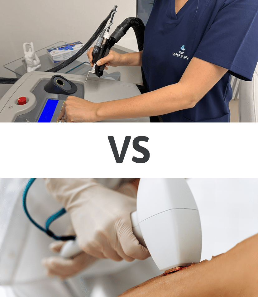 laser-vs-ipl-3